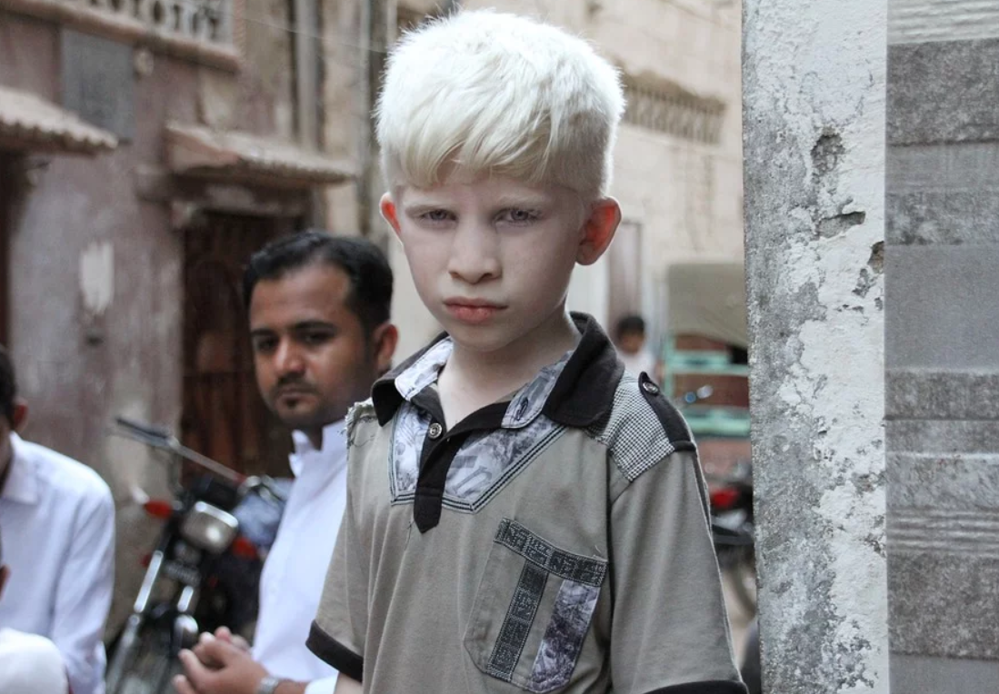 Projekt Erbkrankheit Albinismus Biogymnasiumaltona